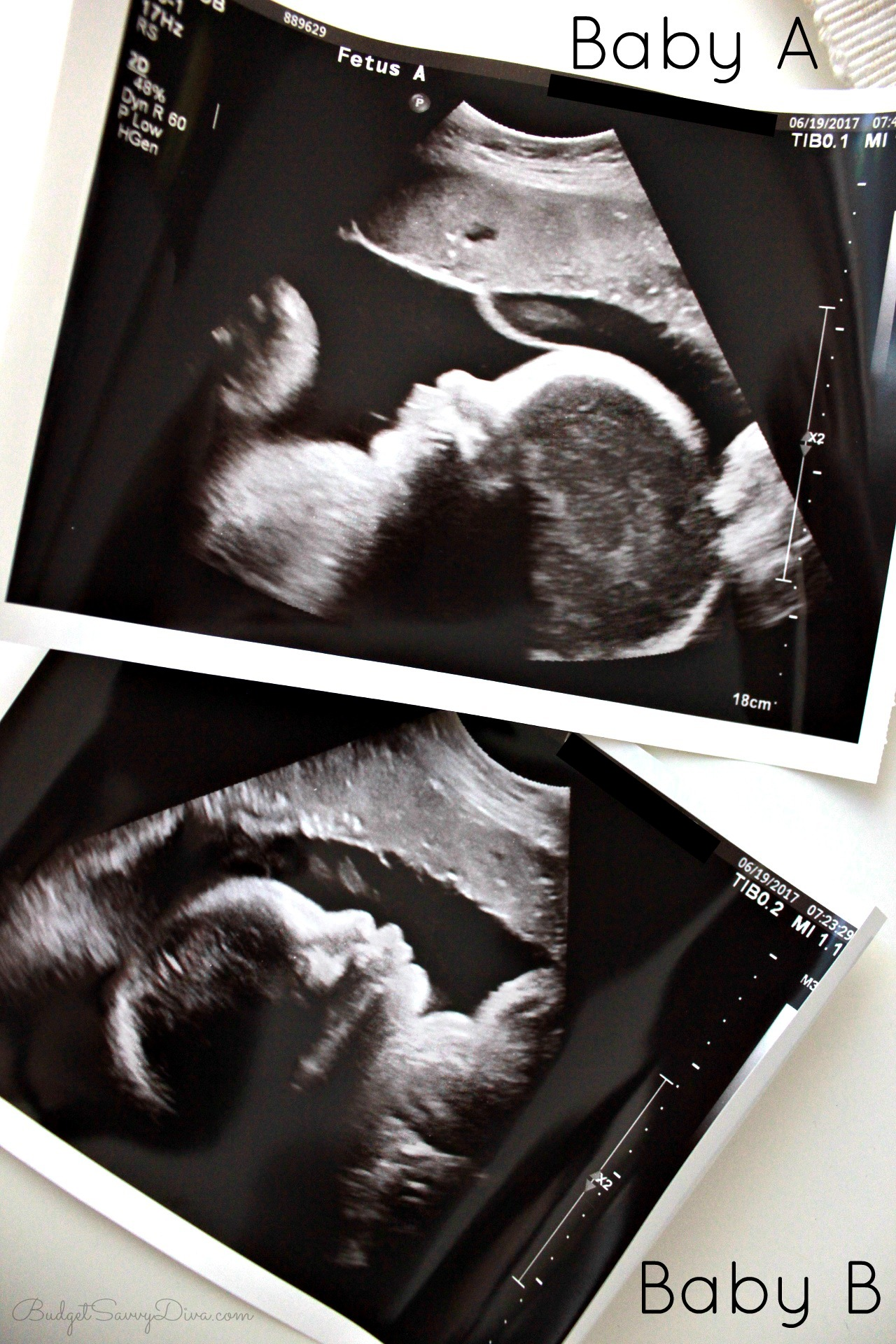 Ultrasound 12 weeks twin Ultrasound at